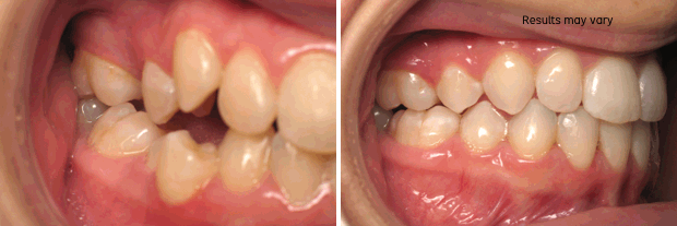 Before and After braces at McCrea DDS