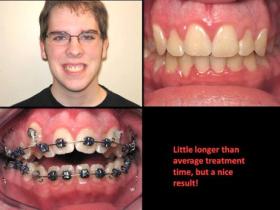 Ortho patient one - after