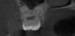 Crazy hooked root! close to sinus on 3rd molar.